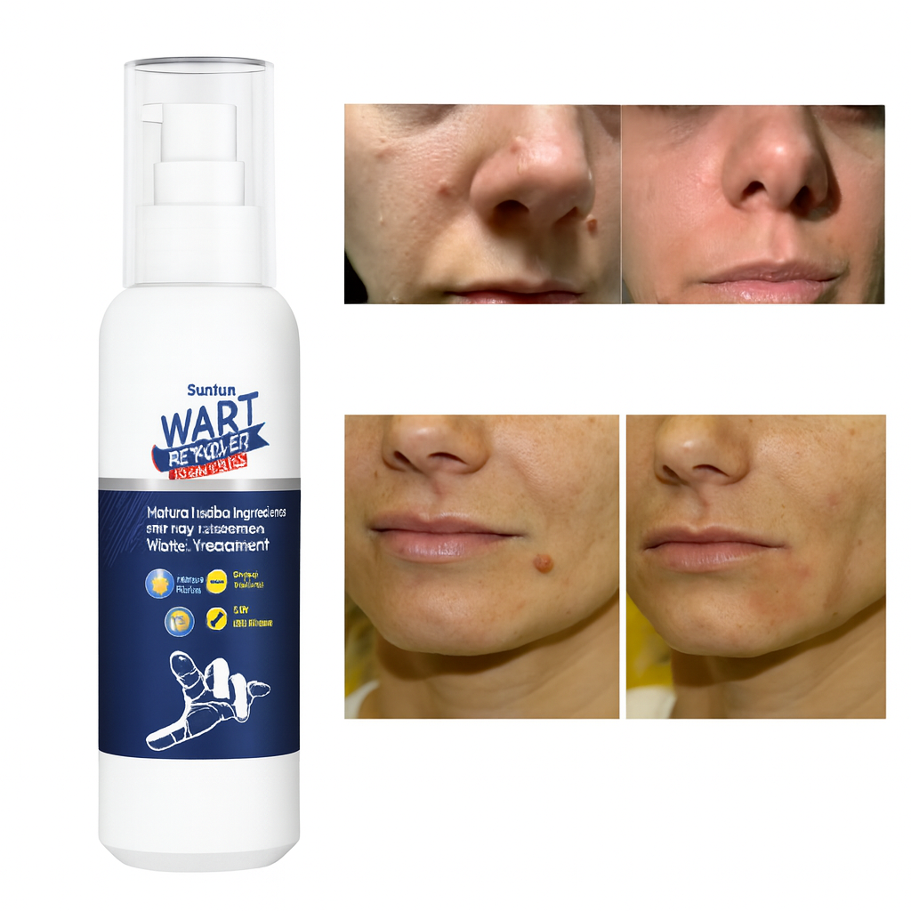 Removedor De Verrugas Wart Remover